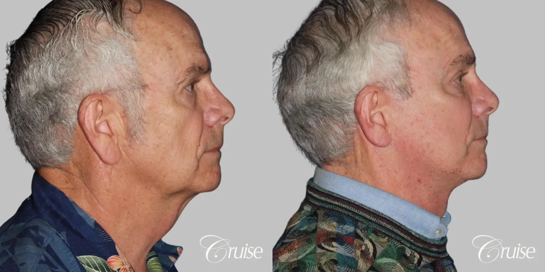 Facelift in Newport Beach, CA - Before and After 3