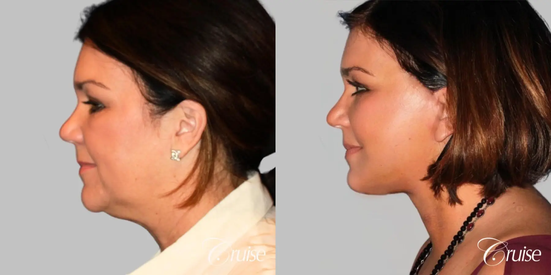 midface with lower face and neck lift orange county - Before and After 3