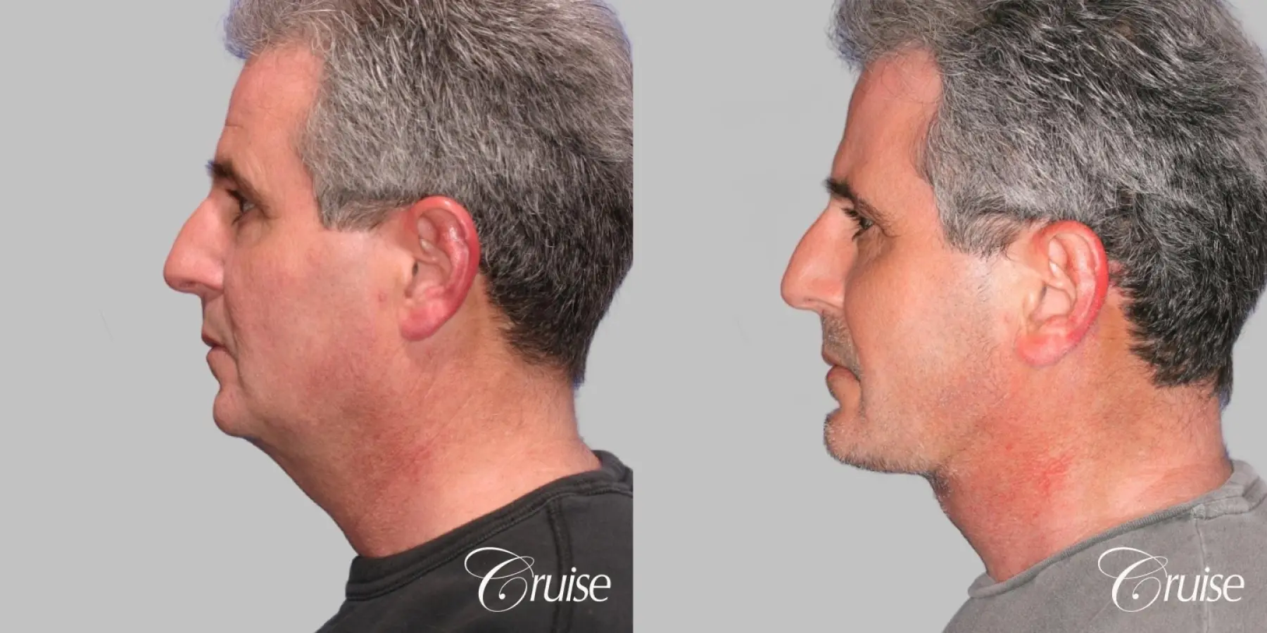 Lower Face/ Neck Lift with Chin Augmentation - Before and After 2