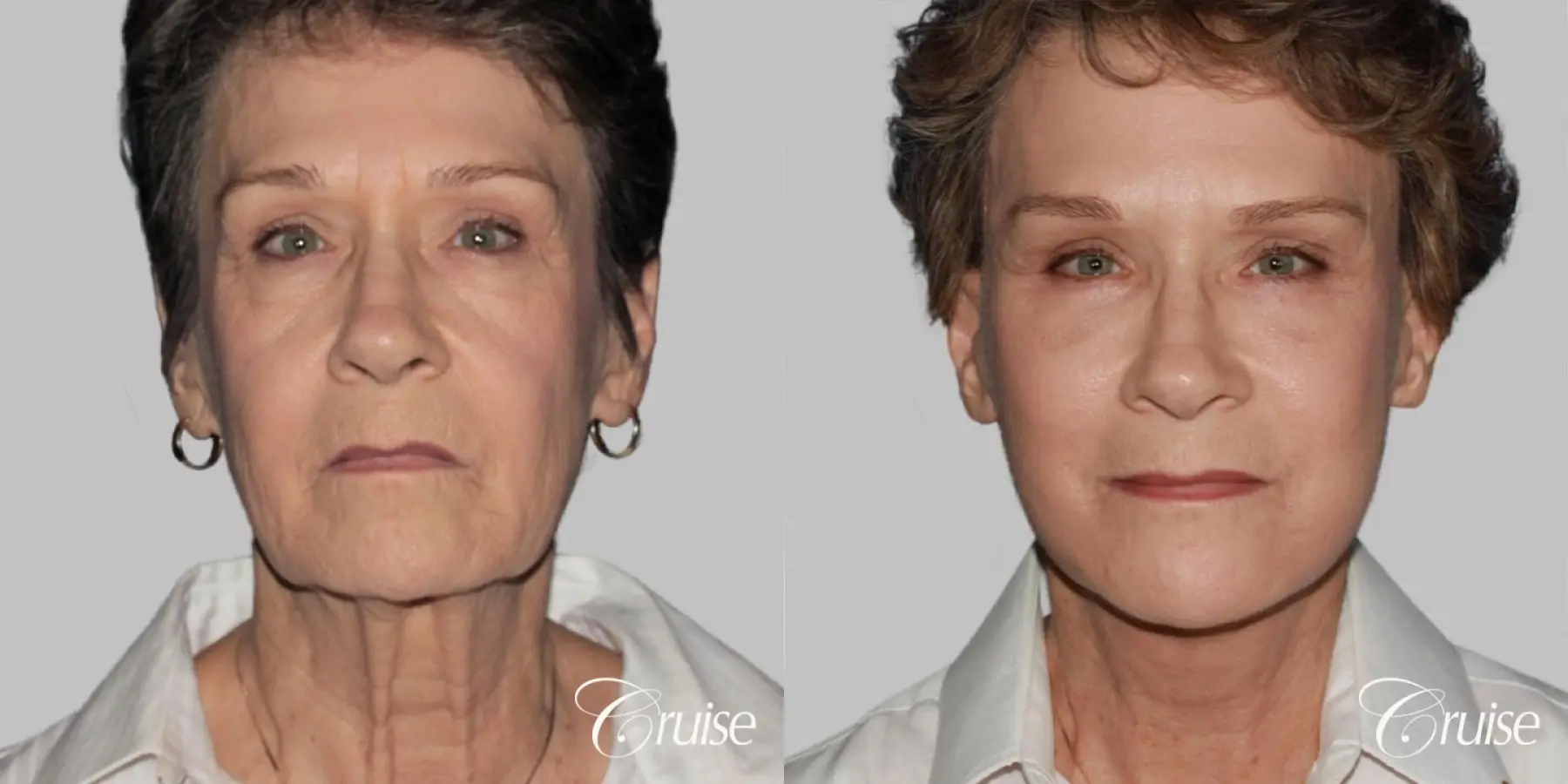 Female Facelift, Blepharoplasty, Necklift, and Temple Lift - Before and After  