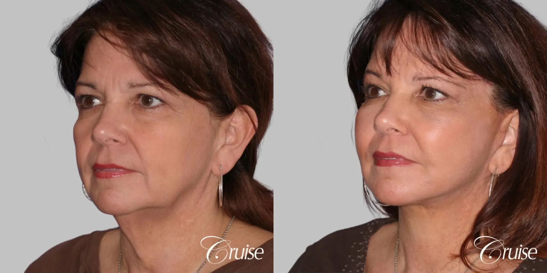 Female - Facelift, Neck Midline Plication, Fat Transfer to Cheeks - Before and After 2