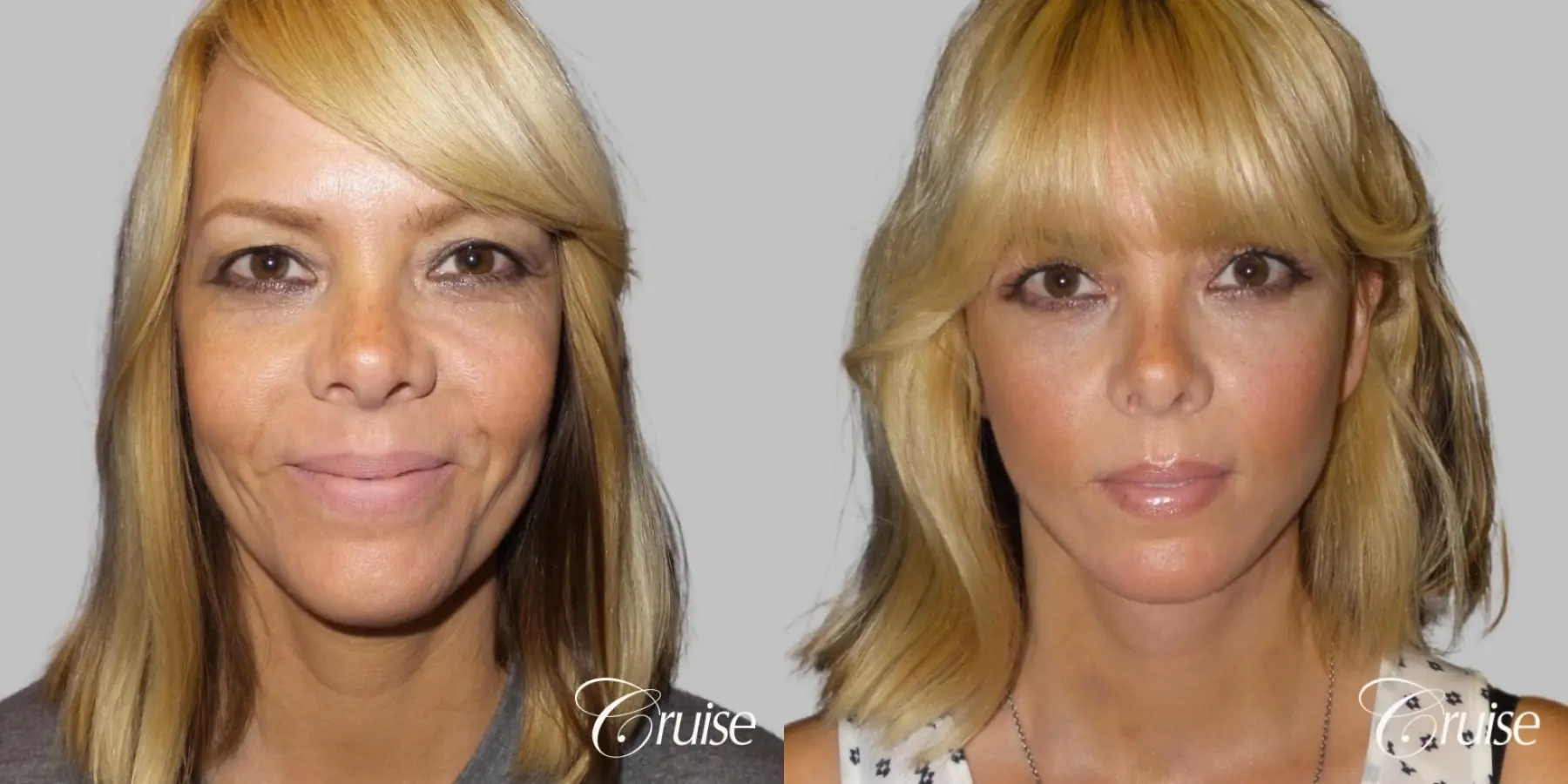 Lower Face Lift with Neck Midline Plication - 45 yr old - Before and After 1