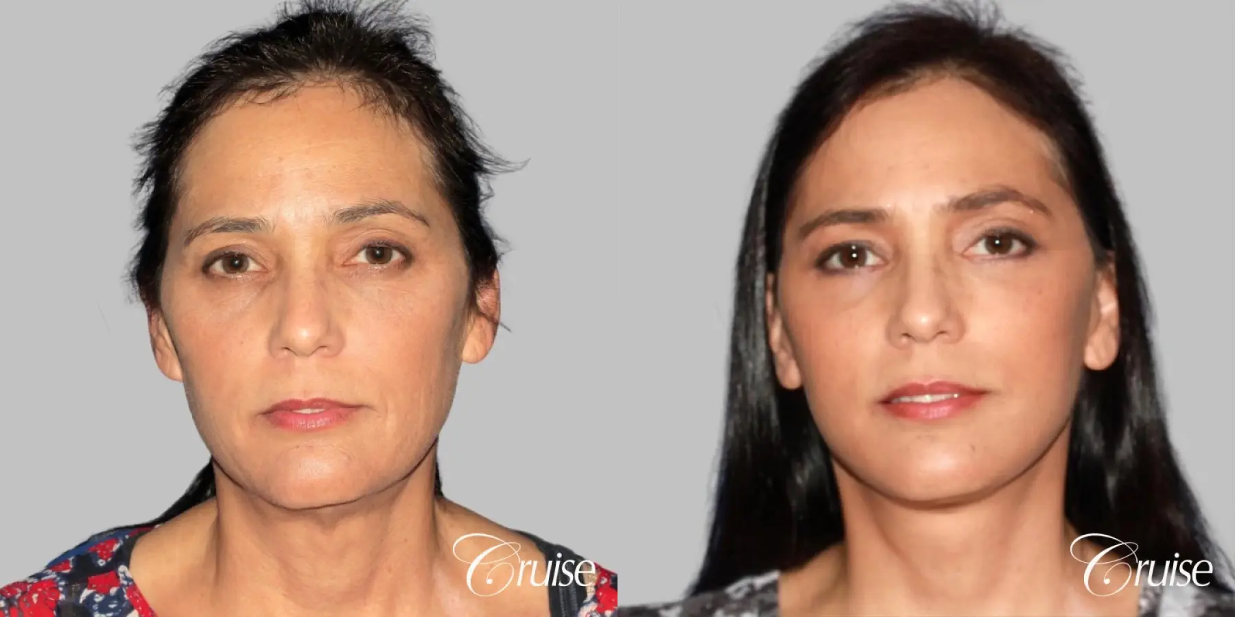 Facelift, Necklift, Lower Eyelid Surgery - Before and After 1