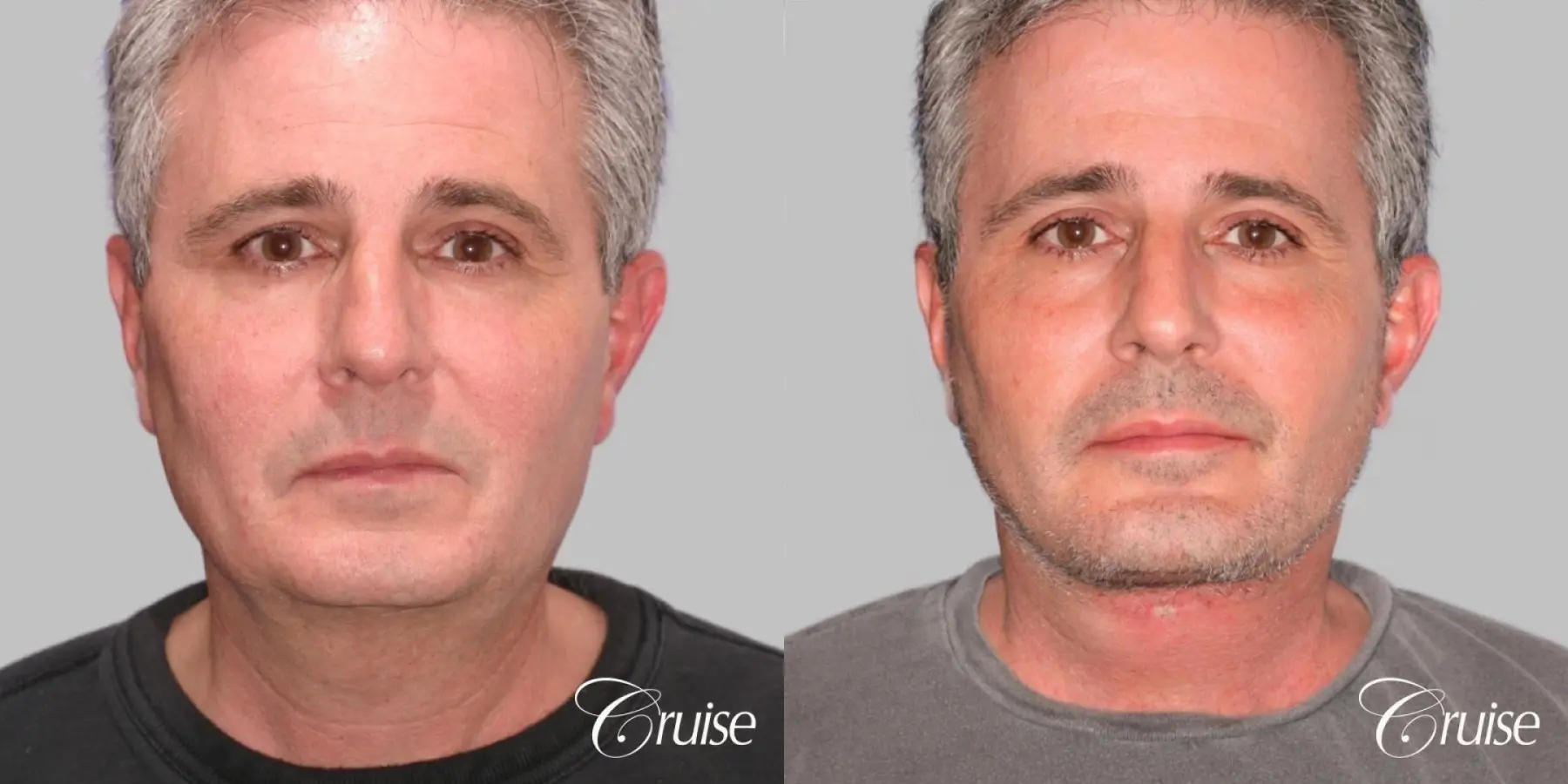 Lower Face/ Neck Lift with Chin Augmentation - Before and After  