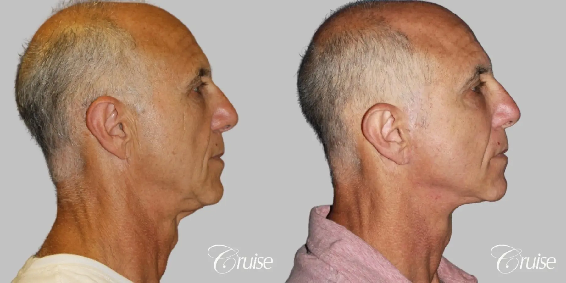 Male - Face Lift, Neck Midline Plication, Fat Transfer - Before and After 3