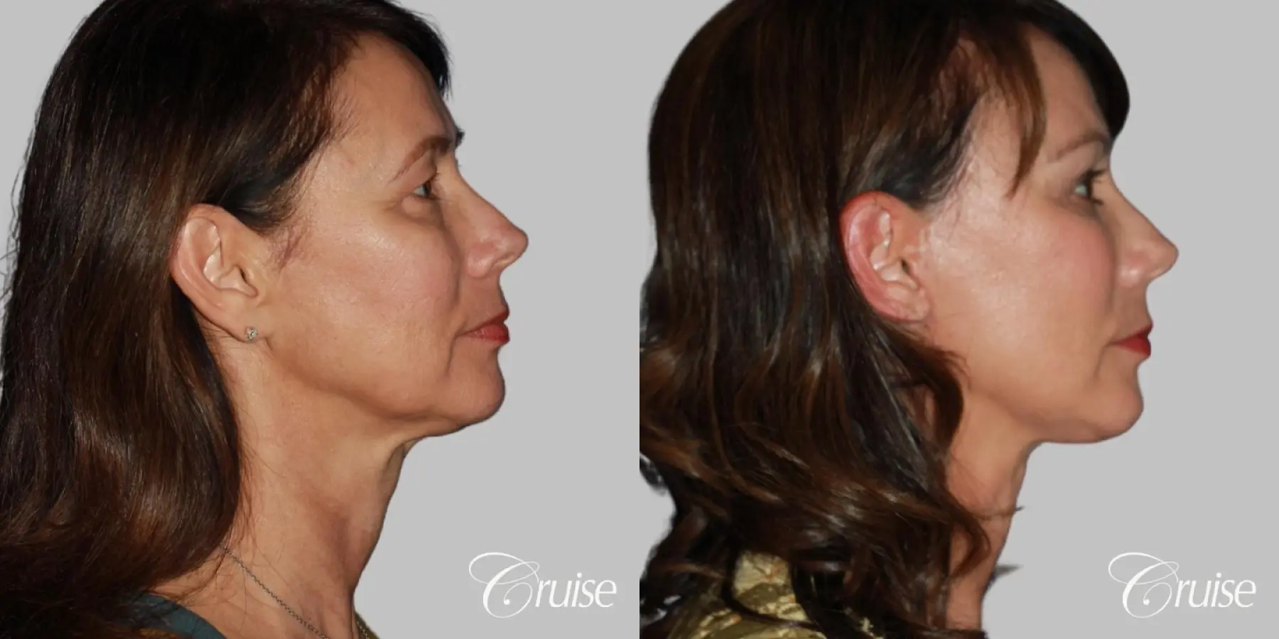 Female Facelift, Neck Midline Plication, Blepharoplasty, and Temple Lift Surgery - Before and After 3