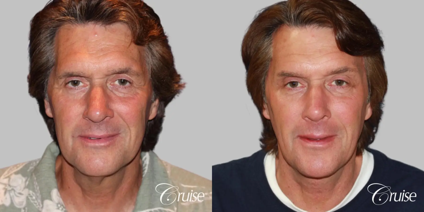 Neck Lift with Liposuction Jawline - Before and After  