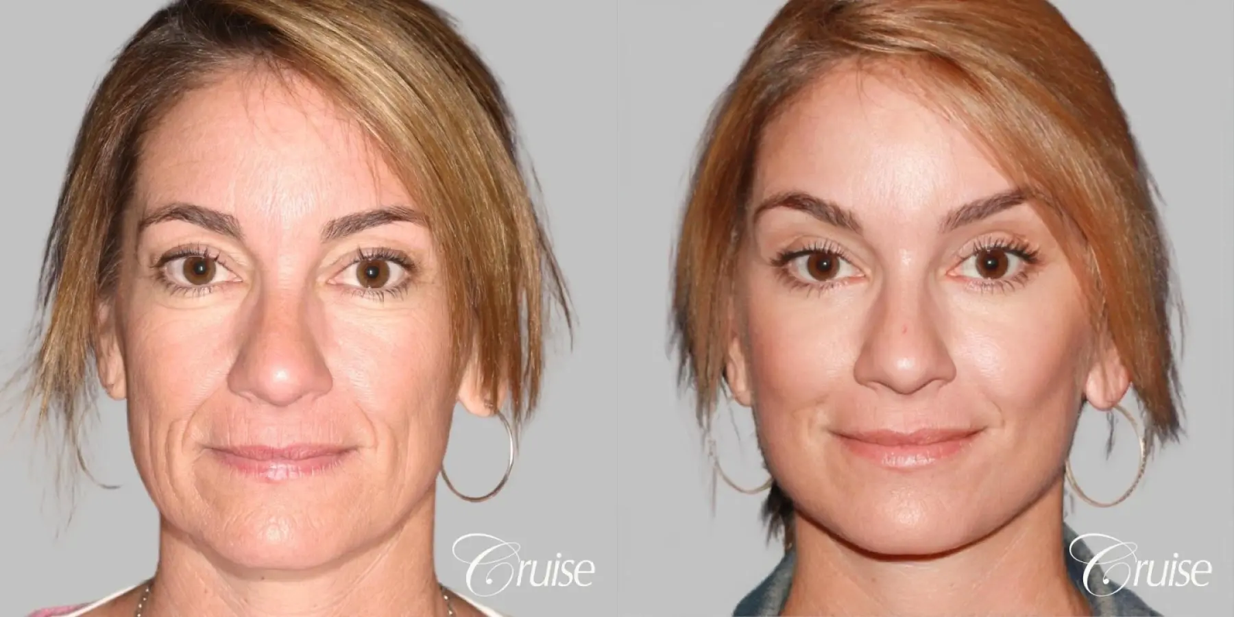 Female - Facelift, Neck Tightening, Fat Transfer - Before and After 1