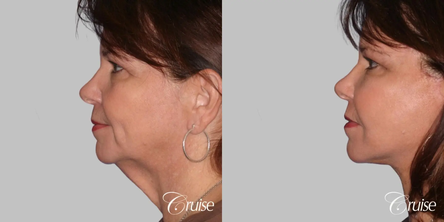 Female - Facelift, Neck Midline Plication, Fat Transfer to Cheeks - Before and After 3