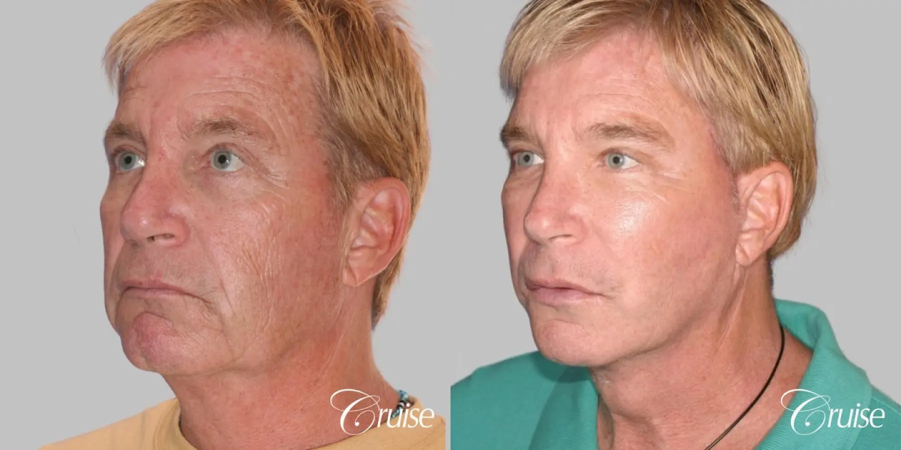 Male Facelift, Browlift, and Fat Transfer - Before and After 2