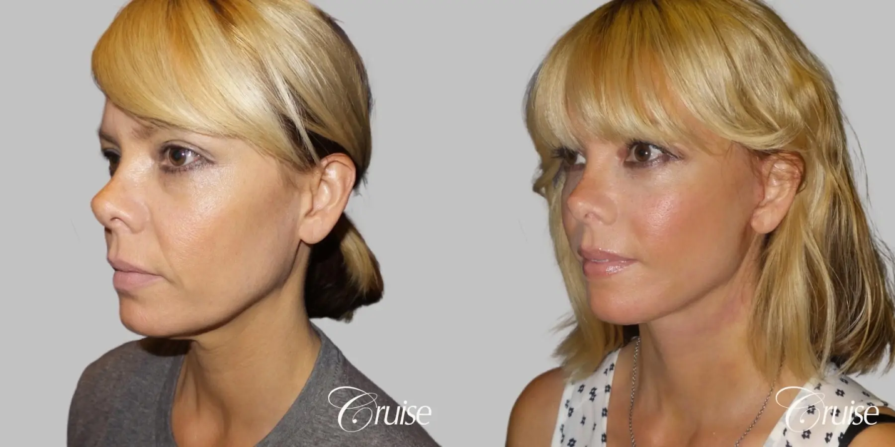 Lower Face Lift with Neck Midline Plication - 45 yr old - Before and After 2