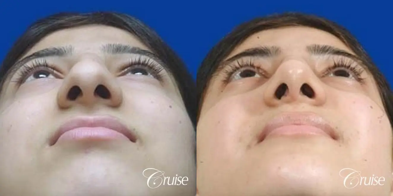 Rhinoplasty: Dorsal Hump Reduction & Bridge Narrowing - Before and After 3