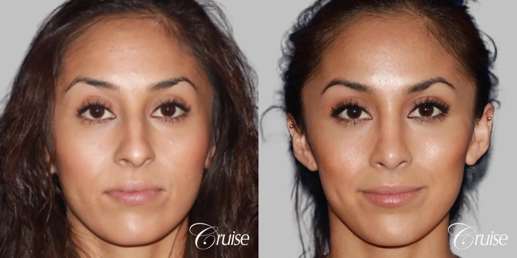 Female Rhinoplasty - Before and After 2