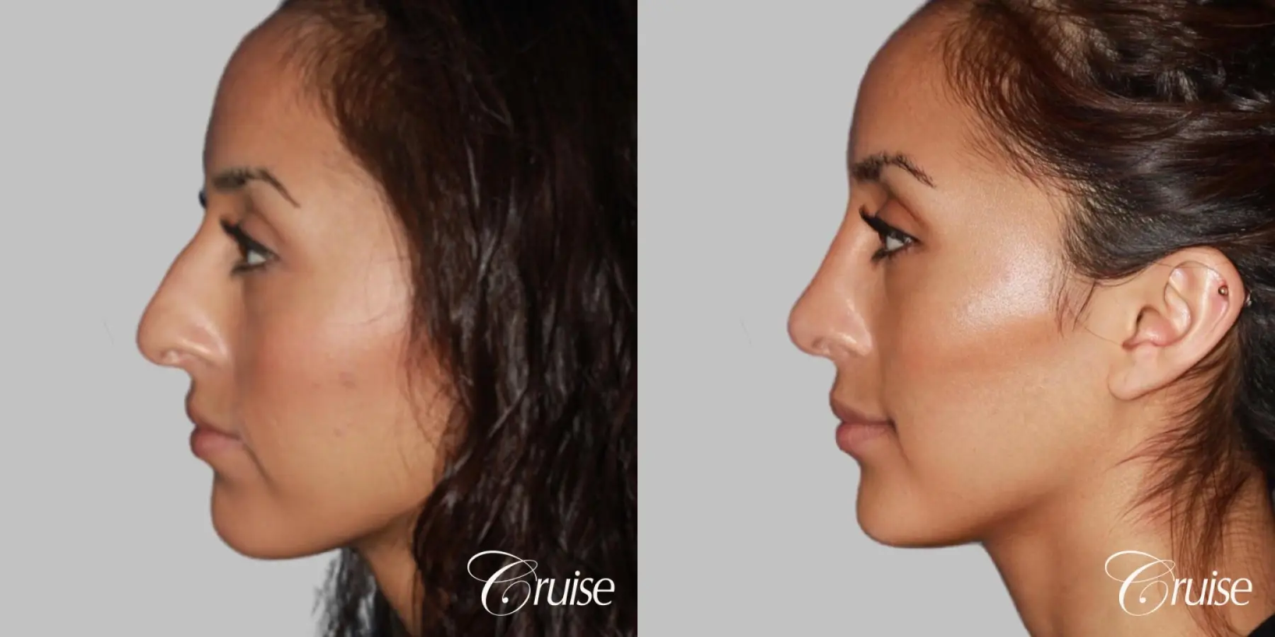 Female Rhinoplasty - Before and After 1