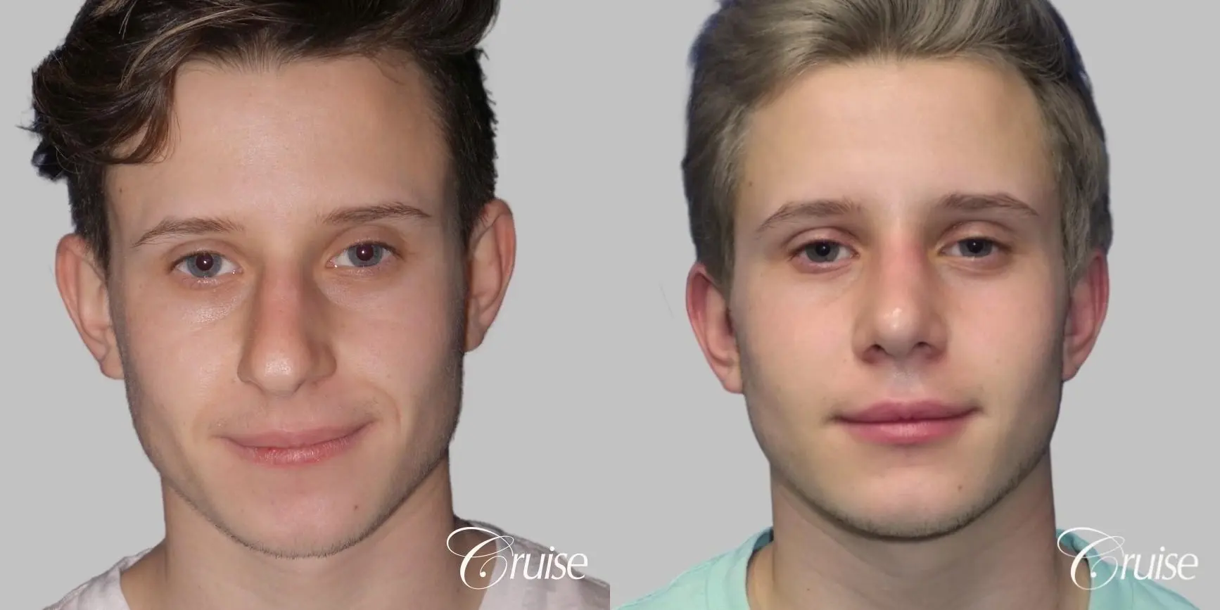 Rhinoplasty & Septoplasty Surgery - Before and After  