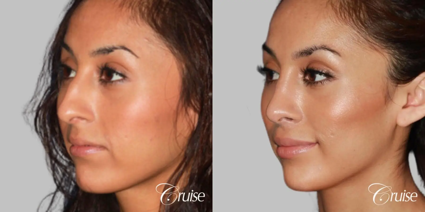 Female Rhinoplasty - Before and After 3