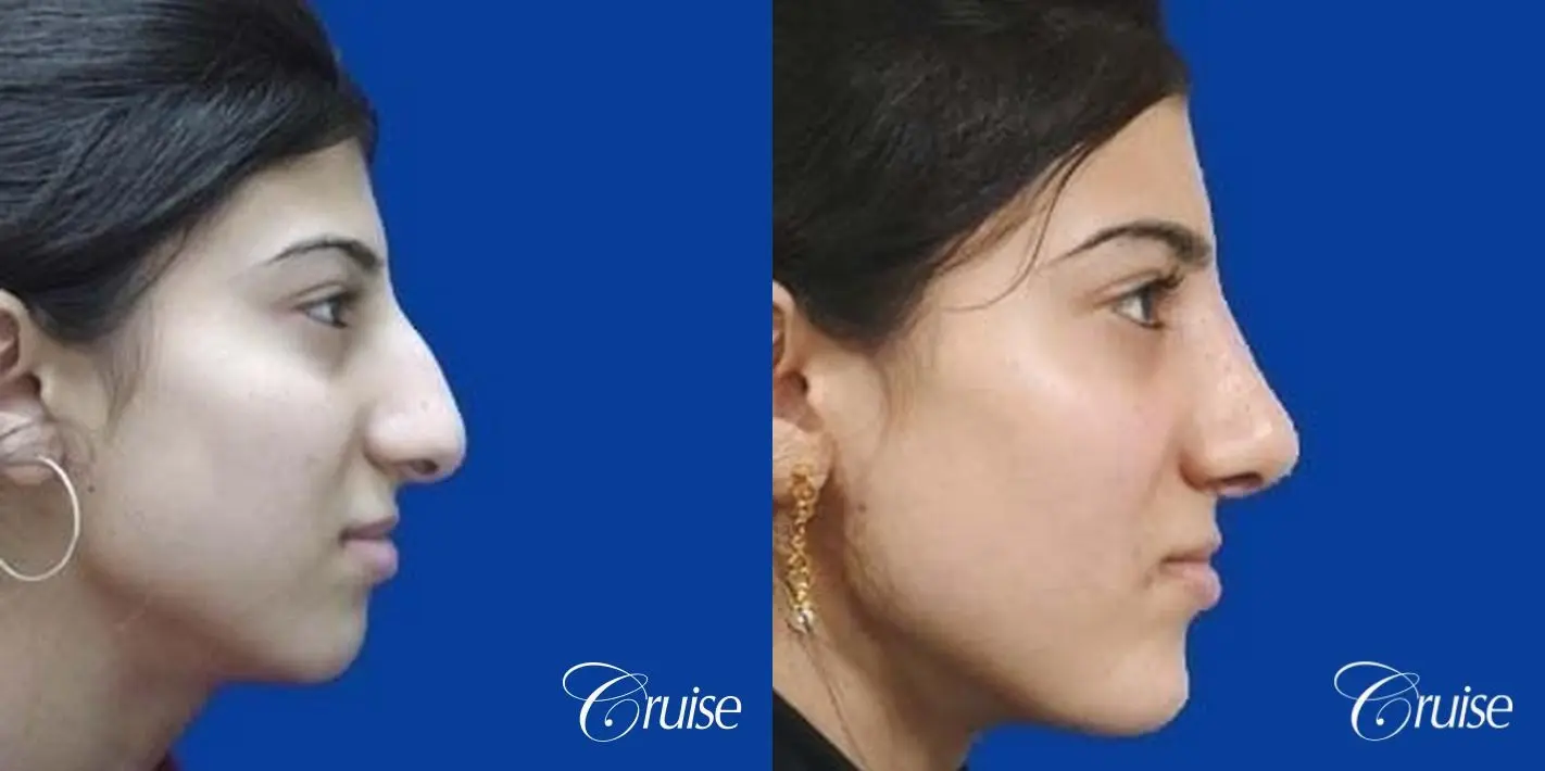 Rhinoplasty: Dorsal Hump Reduction & Bridge Narrowing - Before and After 2