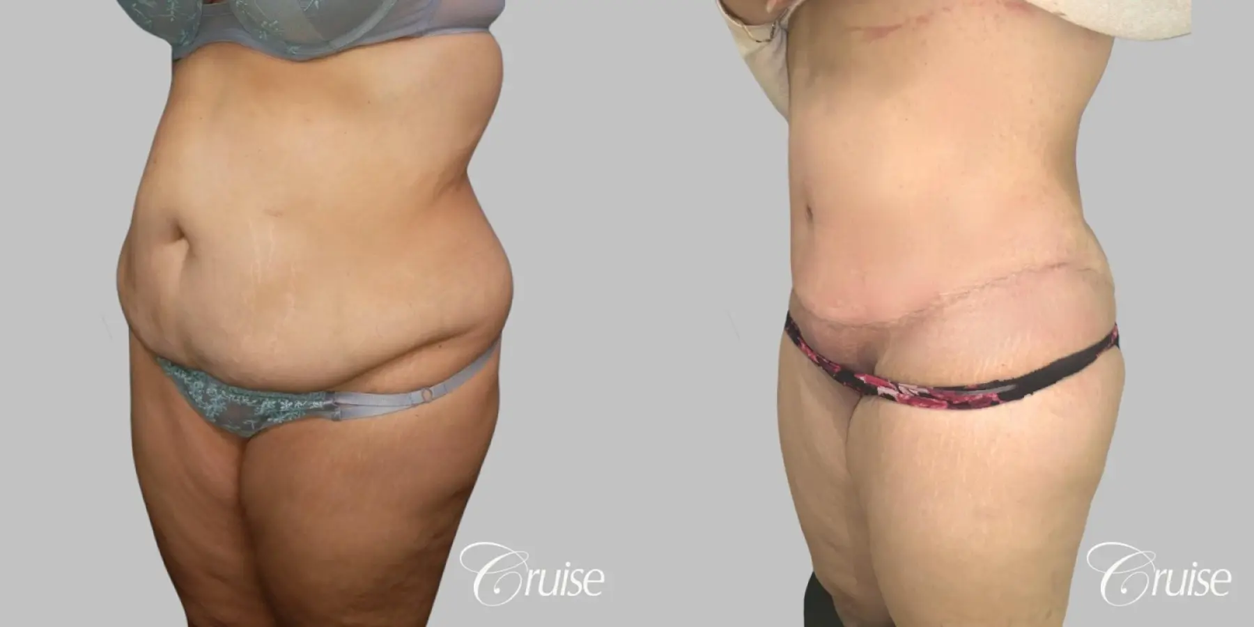 Tummy Tuck - Extended Incision - Before and After 2