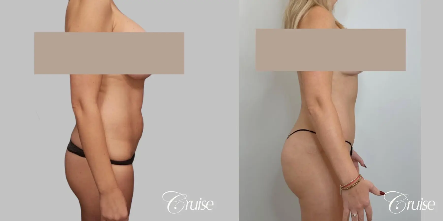 Tummy Tuck Surgery - Standard - Before and After 3