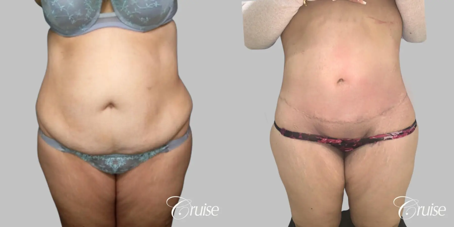 Tummy Tuck - Extended Incision - Before and After  