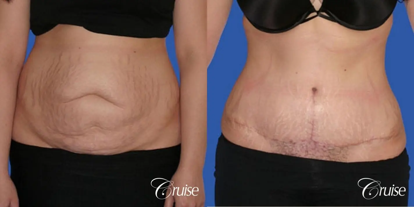 https://www.bragbook.gallery/assets/gallery/220/tummy-tuck-before-and-after-8sgLgoUcDN2j_highres.webp