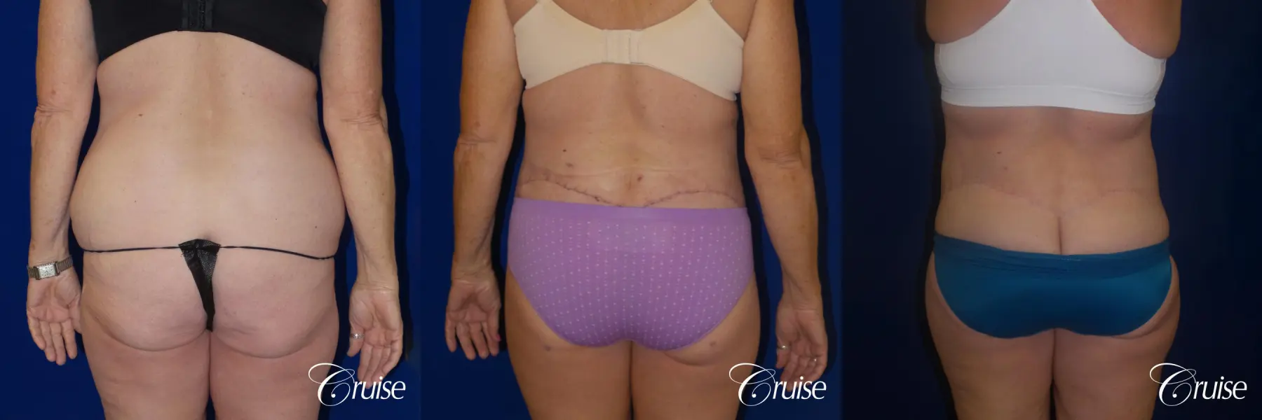 Before and After a Tummy Tuck