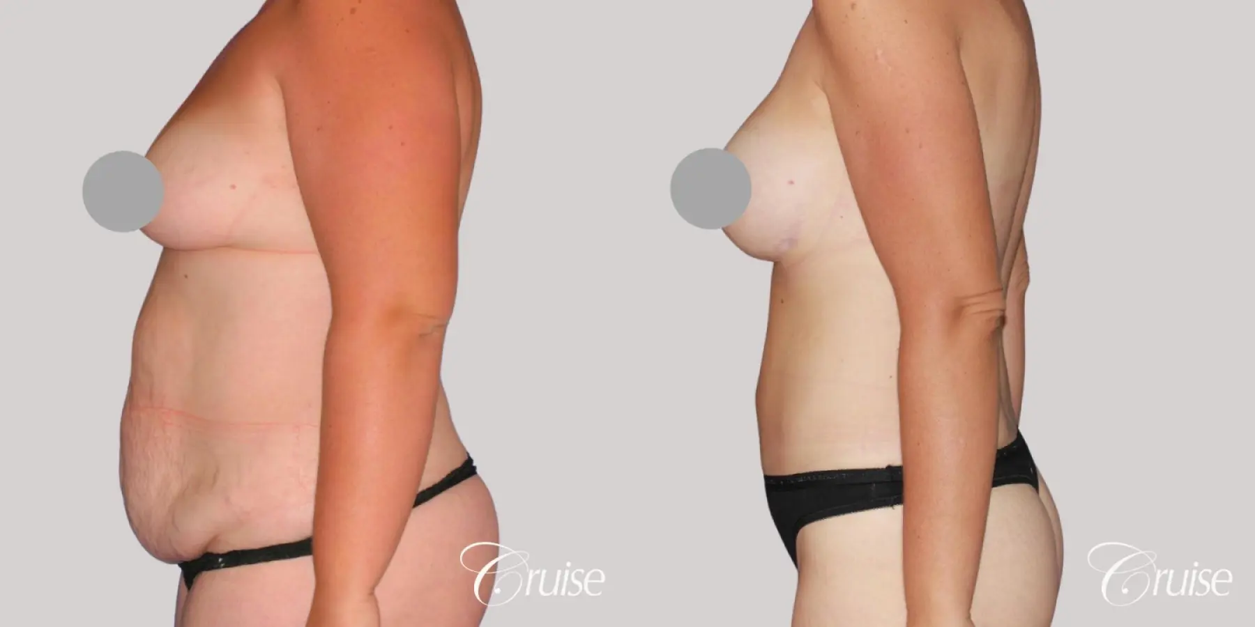 best before and after tummy tuck - Before and After 2