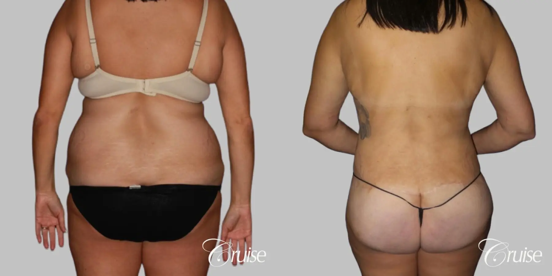 Tummy Tuck with Circumferential Incision - Before and After 3