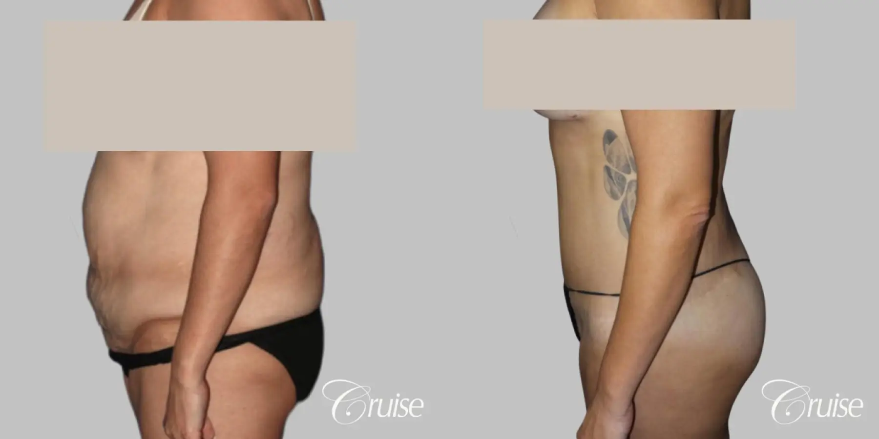 Tummy Tuck with Circumferential Incision - Before and After 2