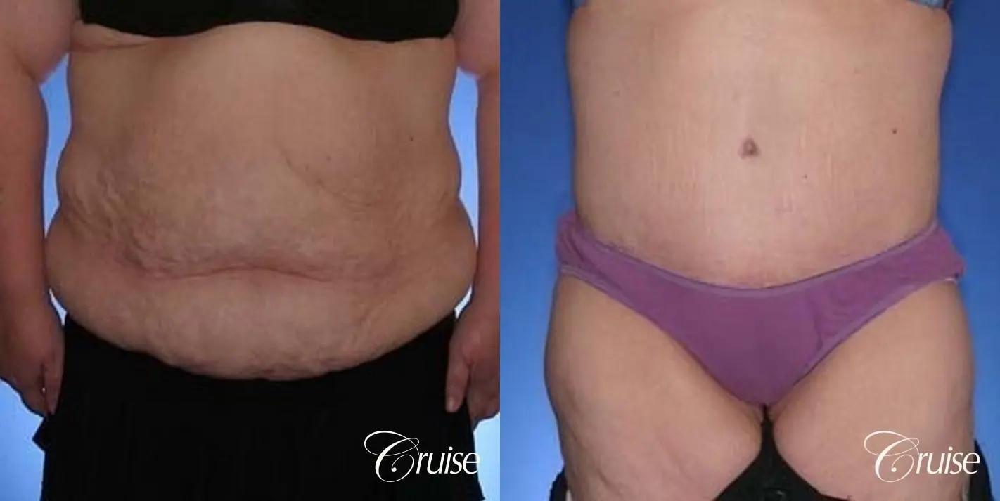 https://www.bragbook.gallery/assets/gallery/220/tummy-tuck-before-and-after-MAiJ3e17ci6V_highres.webp