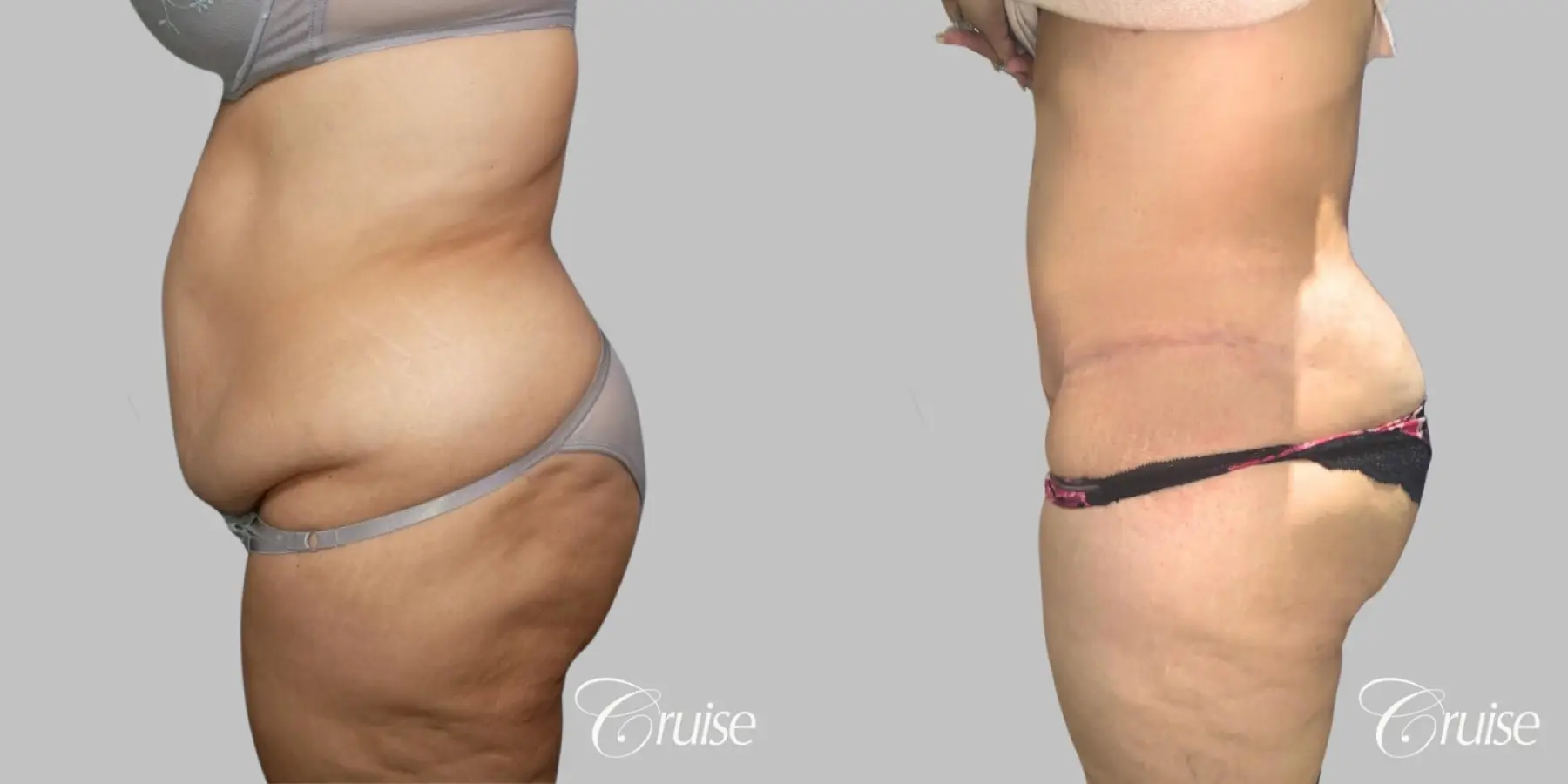 Tummy Tuck - Extended Incision - Before and After 3