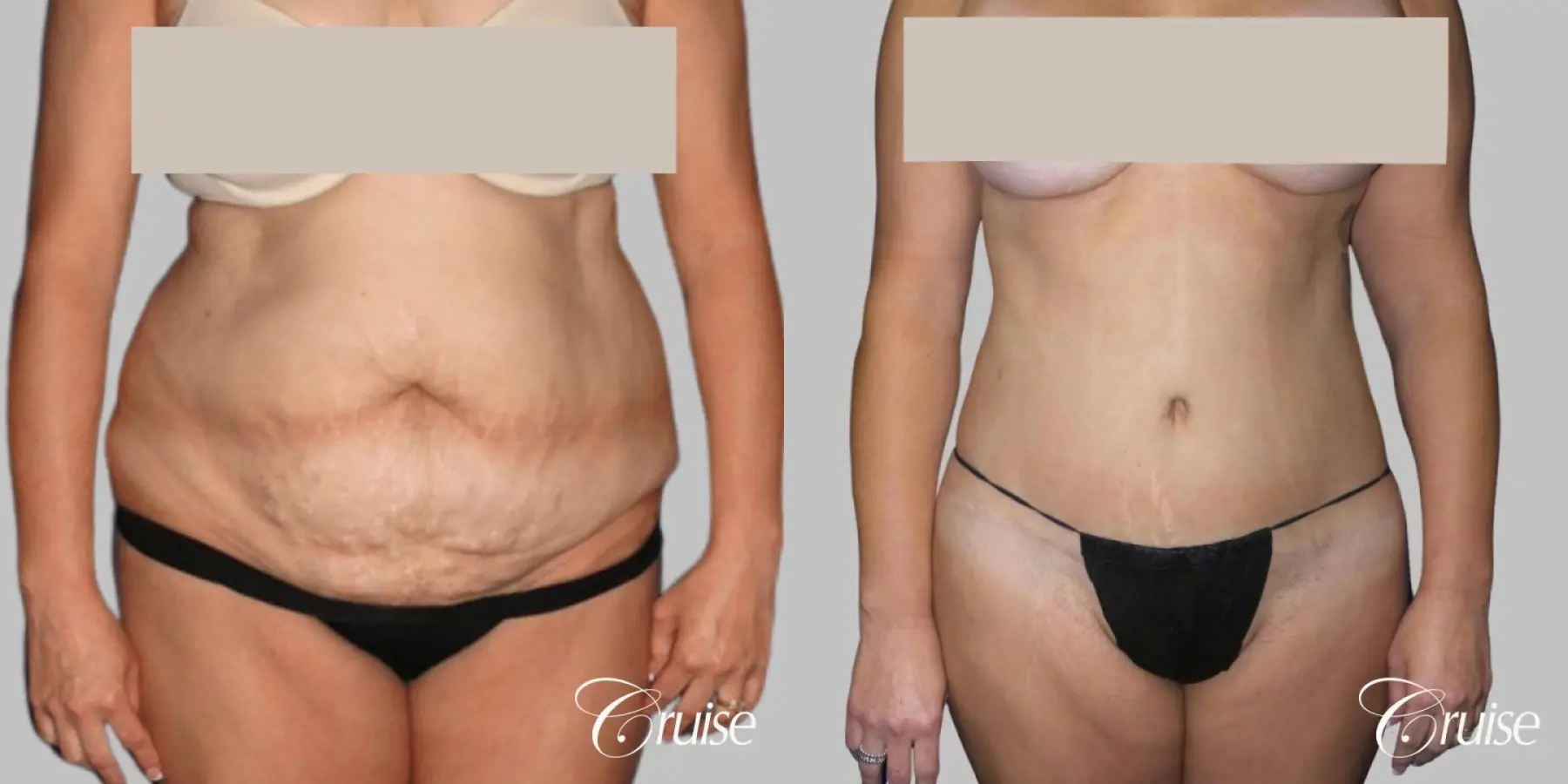 Tummy Tuck with Circumferential Incision - Before and After  