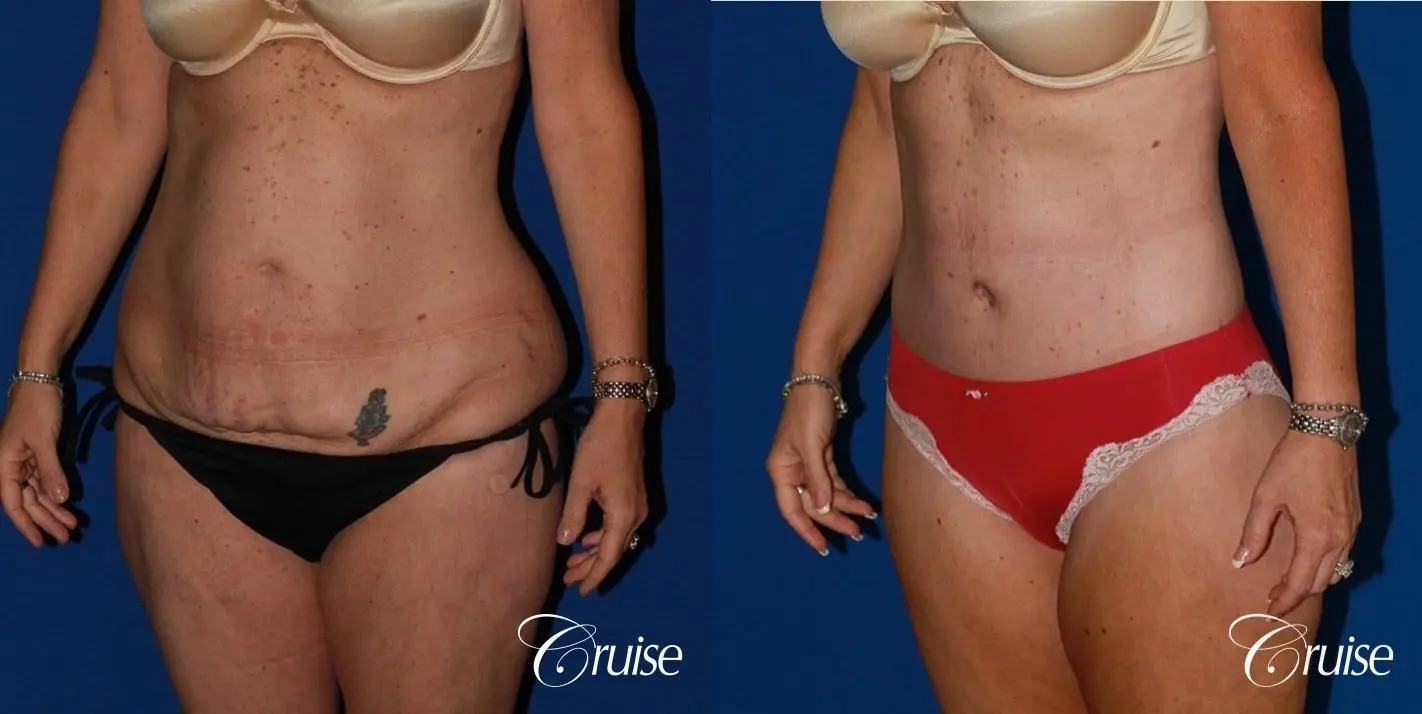 Tummy Tuck Before & After Gallery: Patient 16