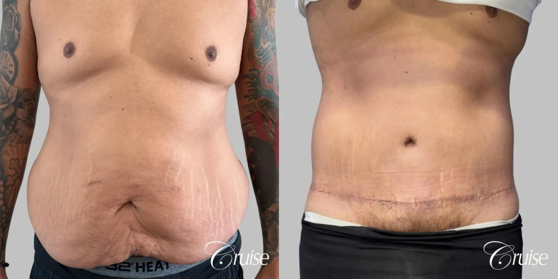 Male Tummy Tuck - Circumferential  - Before and After  