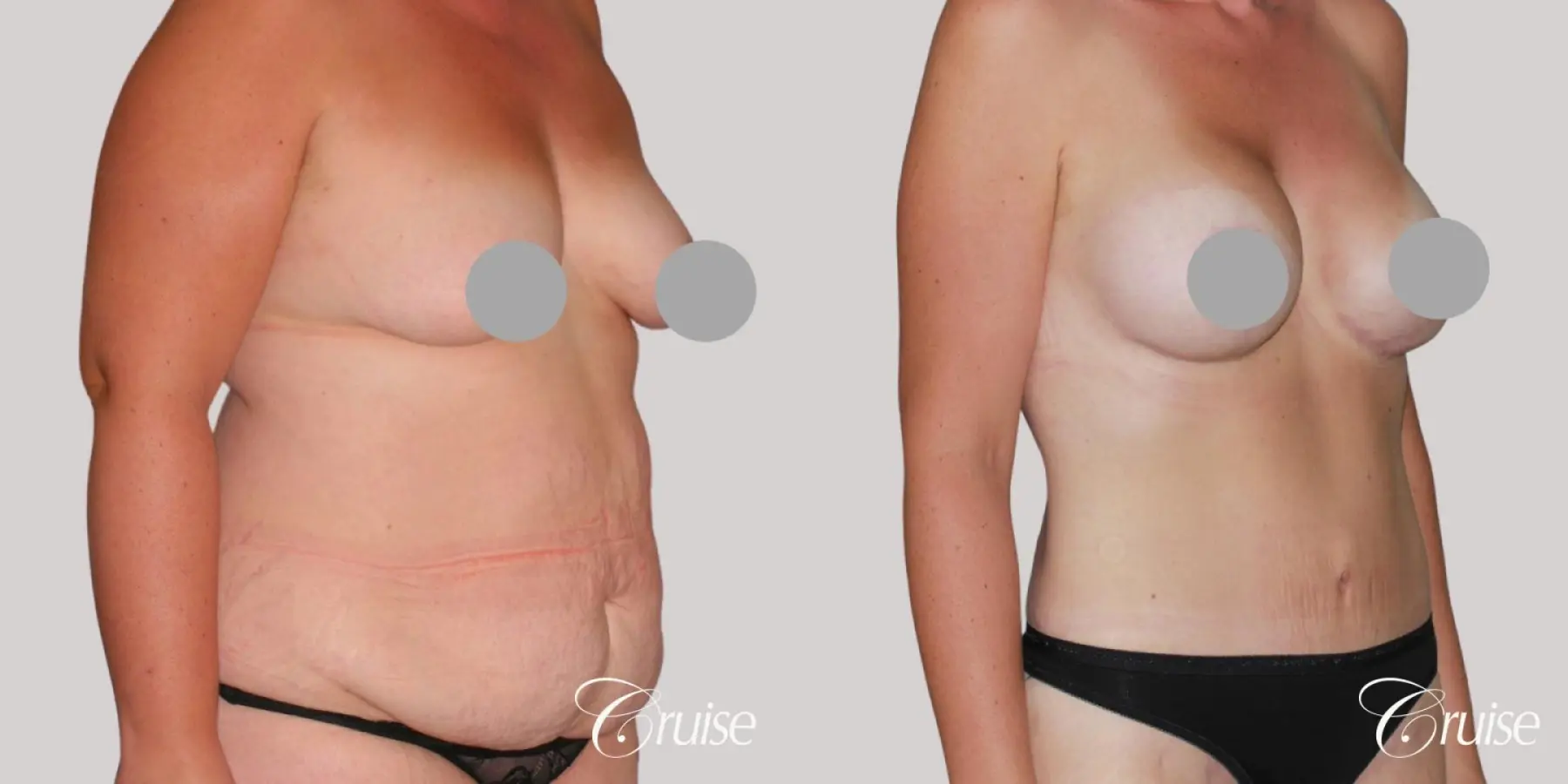 best before and after tummy tuck - Before and After 4