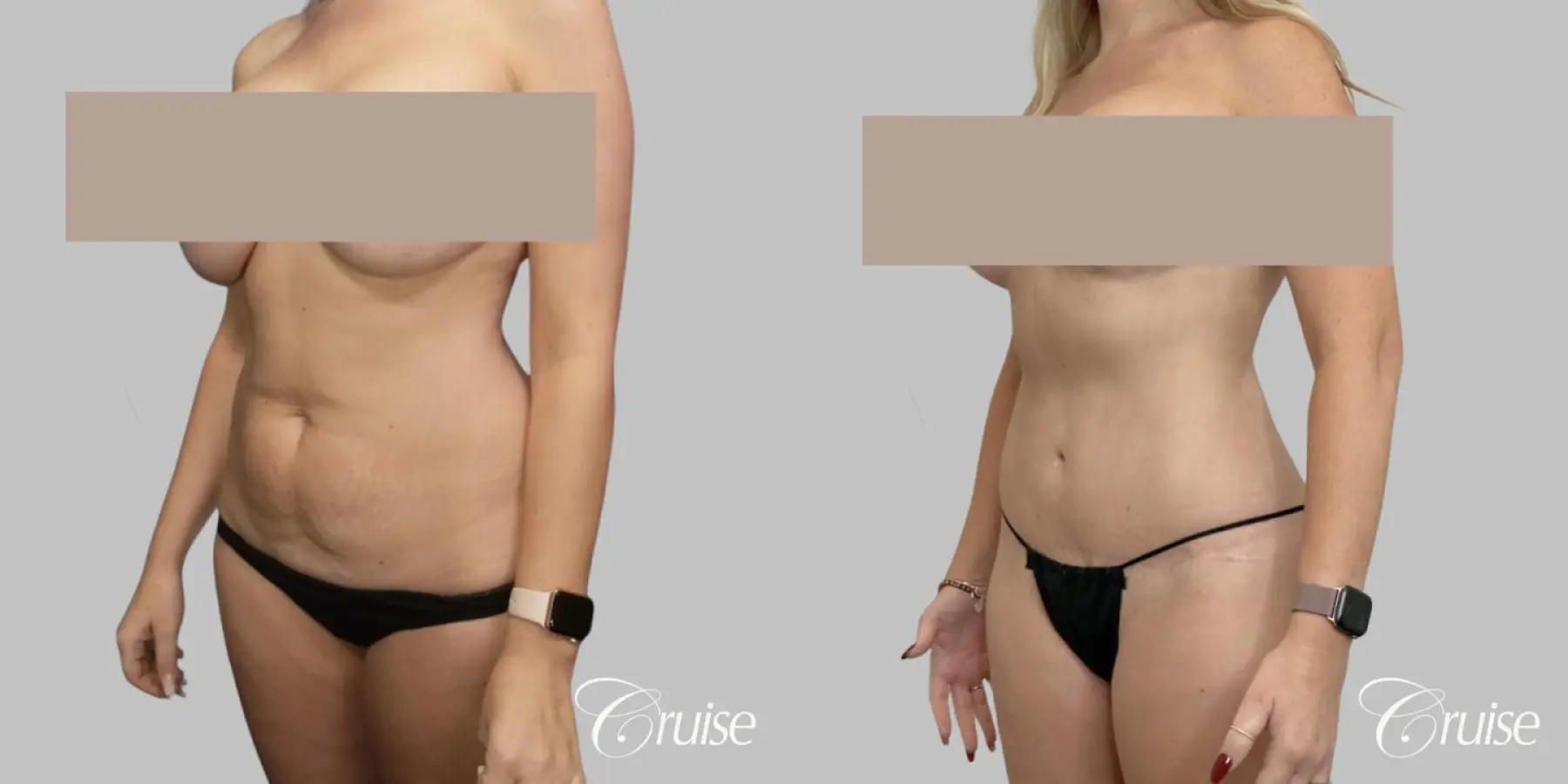 Tummy Tuck Surgery - Standard - Before and After 2