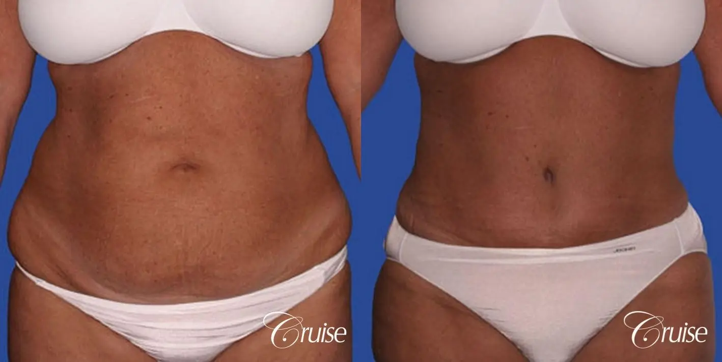 Patient Waist Tuck Before and Afters Waist Tuck Before After