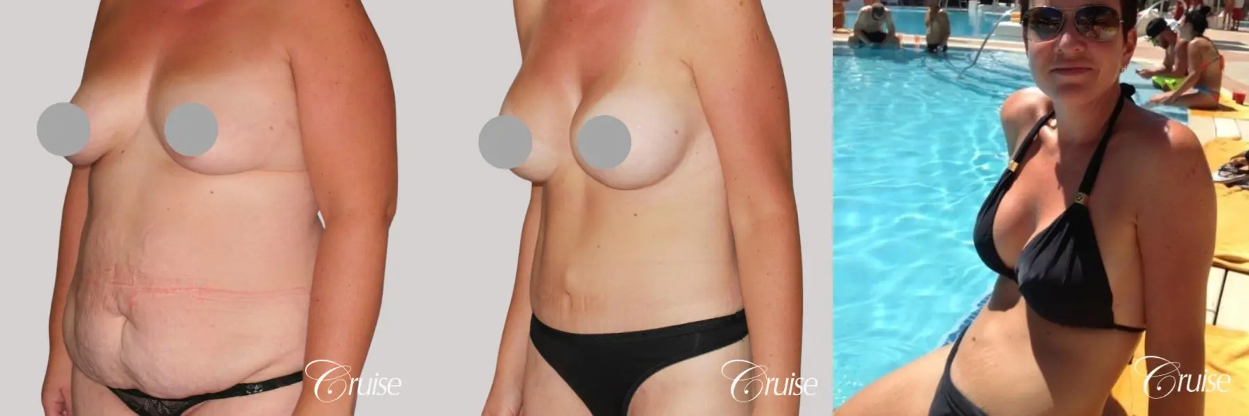 best before and after tummy tuck - Before and After 3