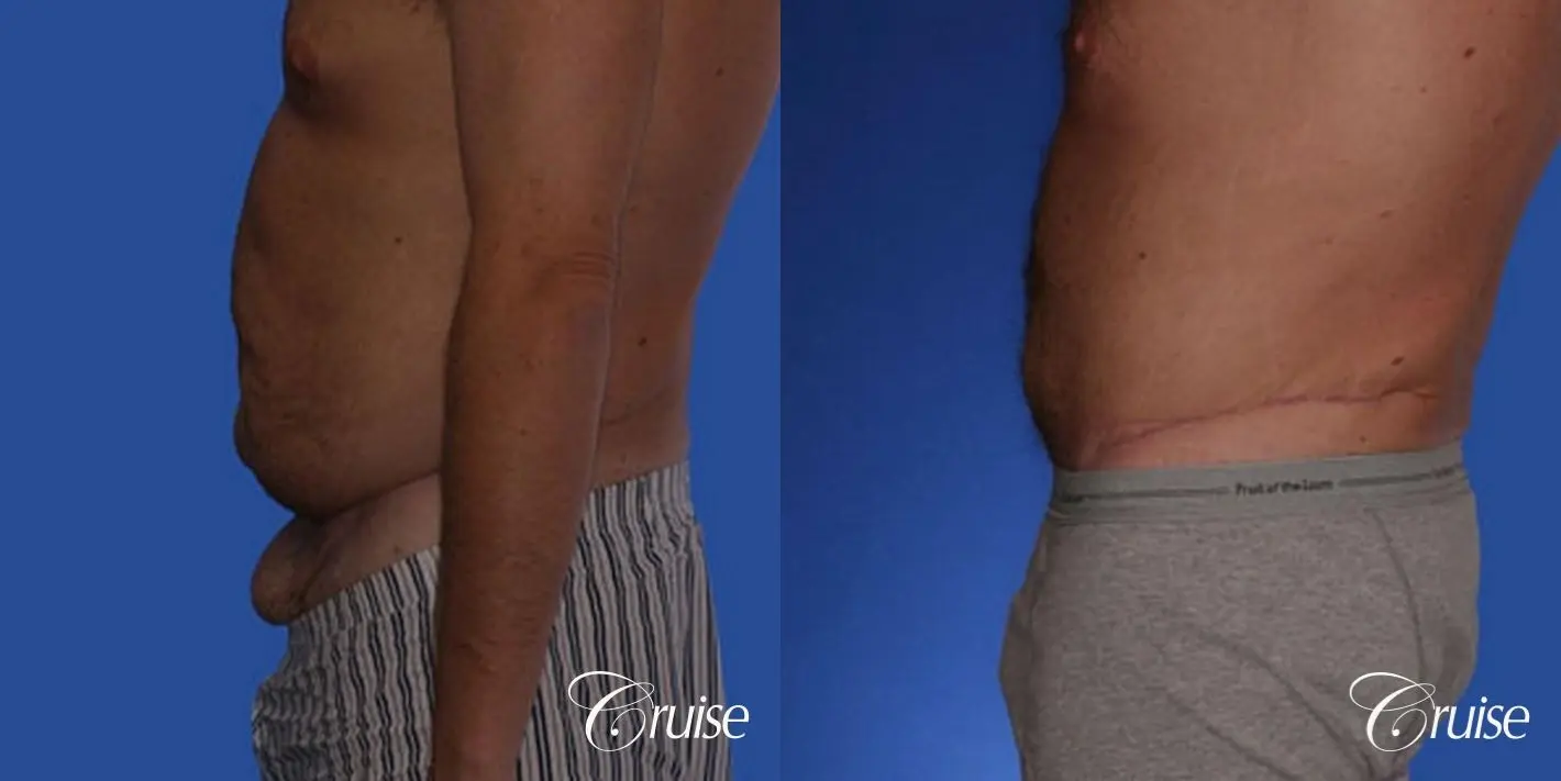 Male Tummy Tuck - Before and After Photos
