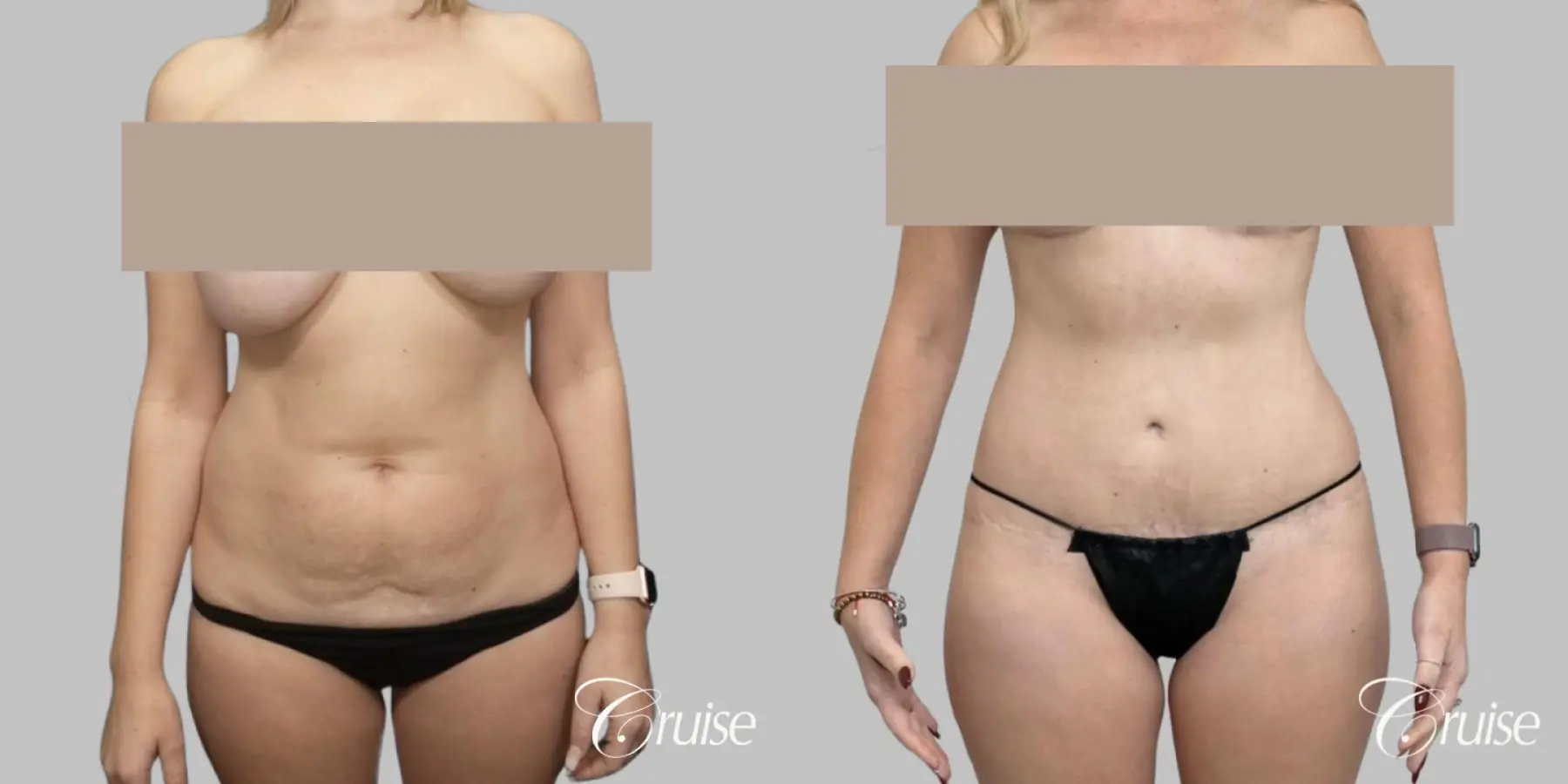 Tummy Tuck Surgery - Standard - Before and After  