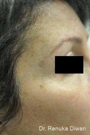 lasers spots brown before patient