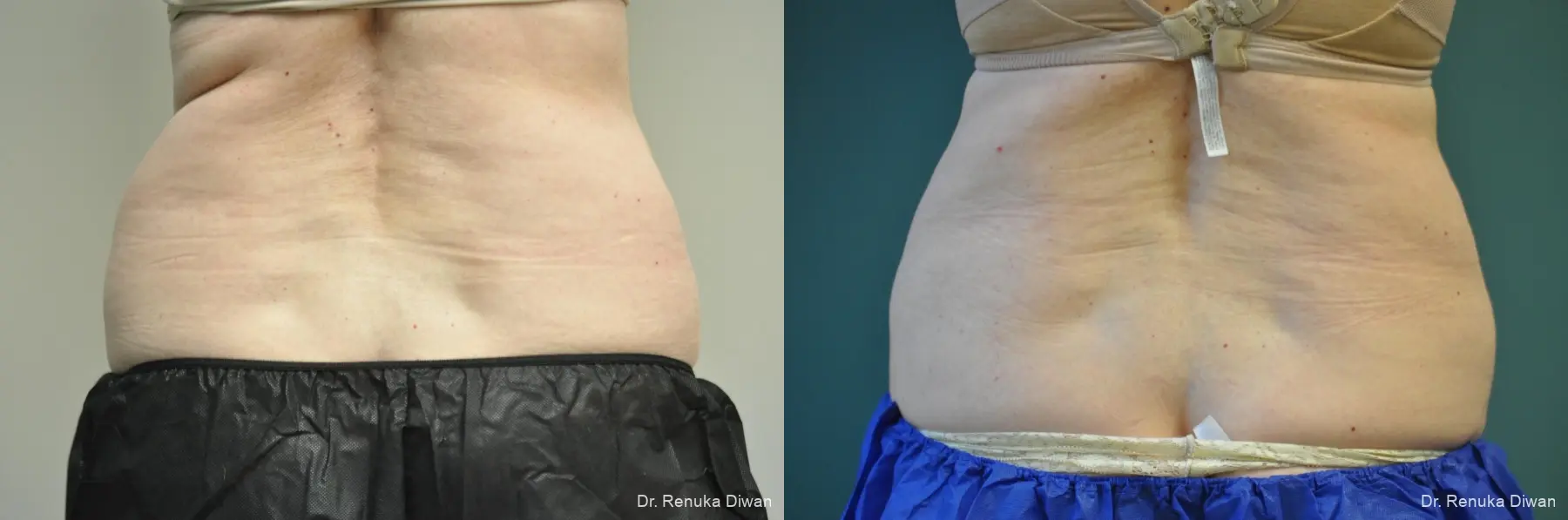 CoolSculpting®: Patient 5 - Before and After  