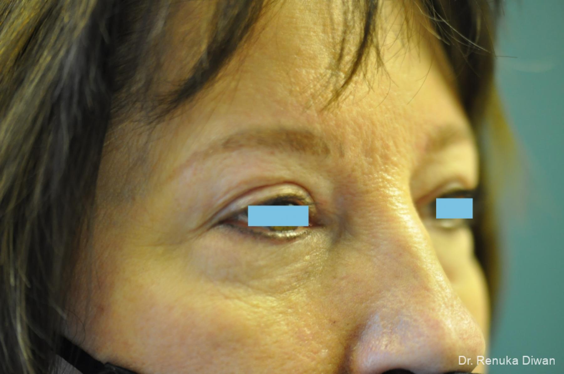 Blepharoplasty Before And After Gallery Patient 3