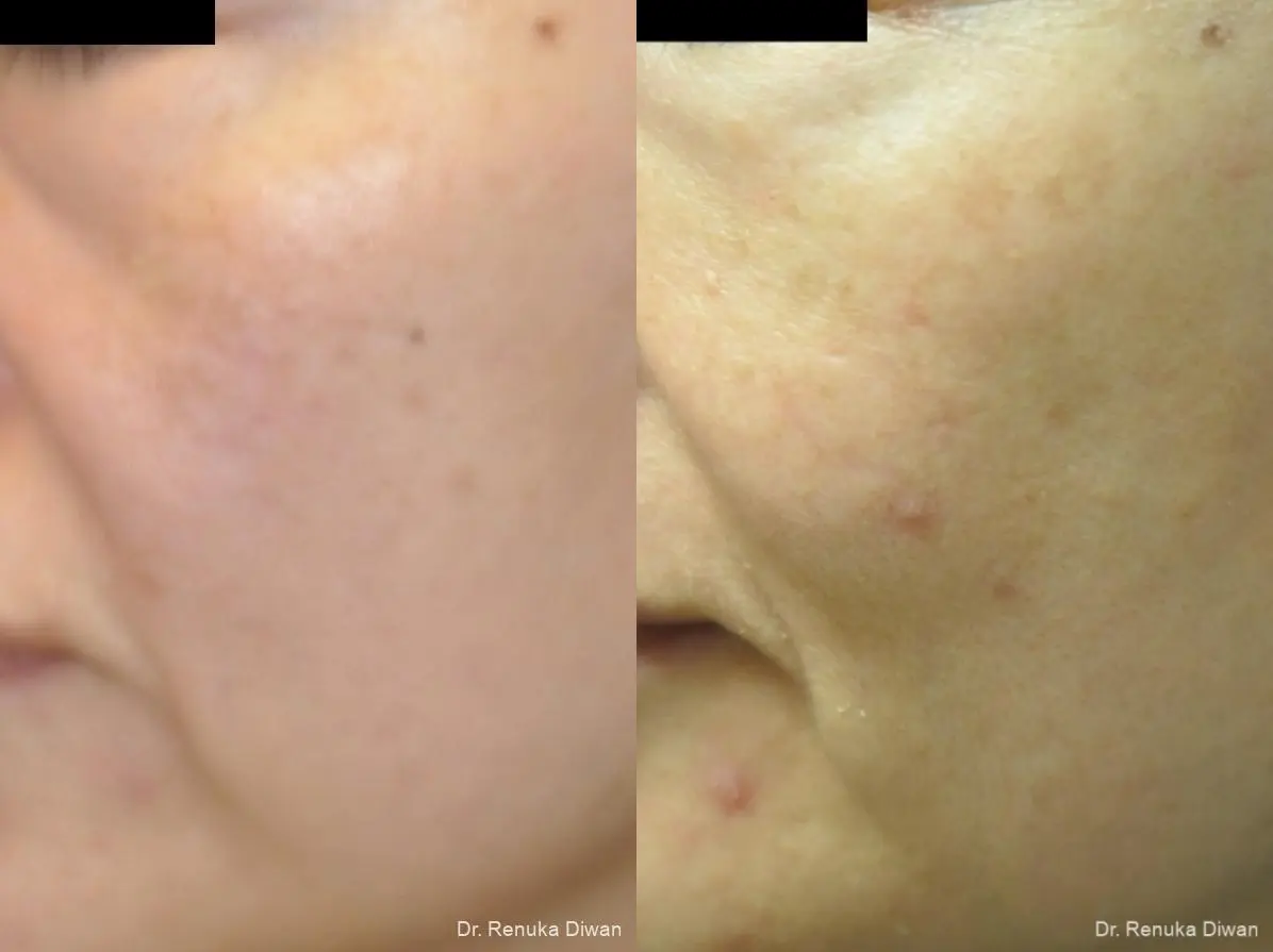 Lasers For Brown Spots: Patient 10 - Before and After 2