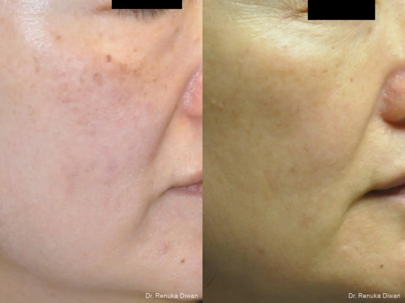 Lasers For Brown Spots: Patient 10 - Before and After 1