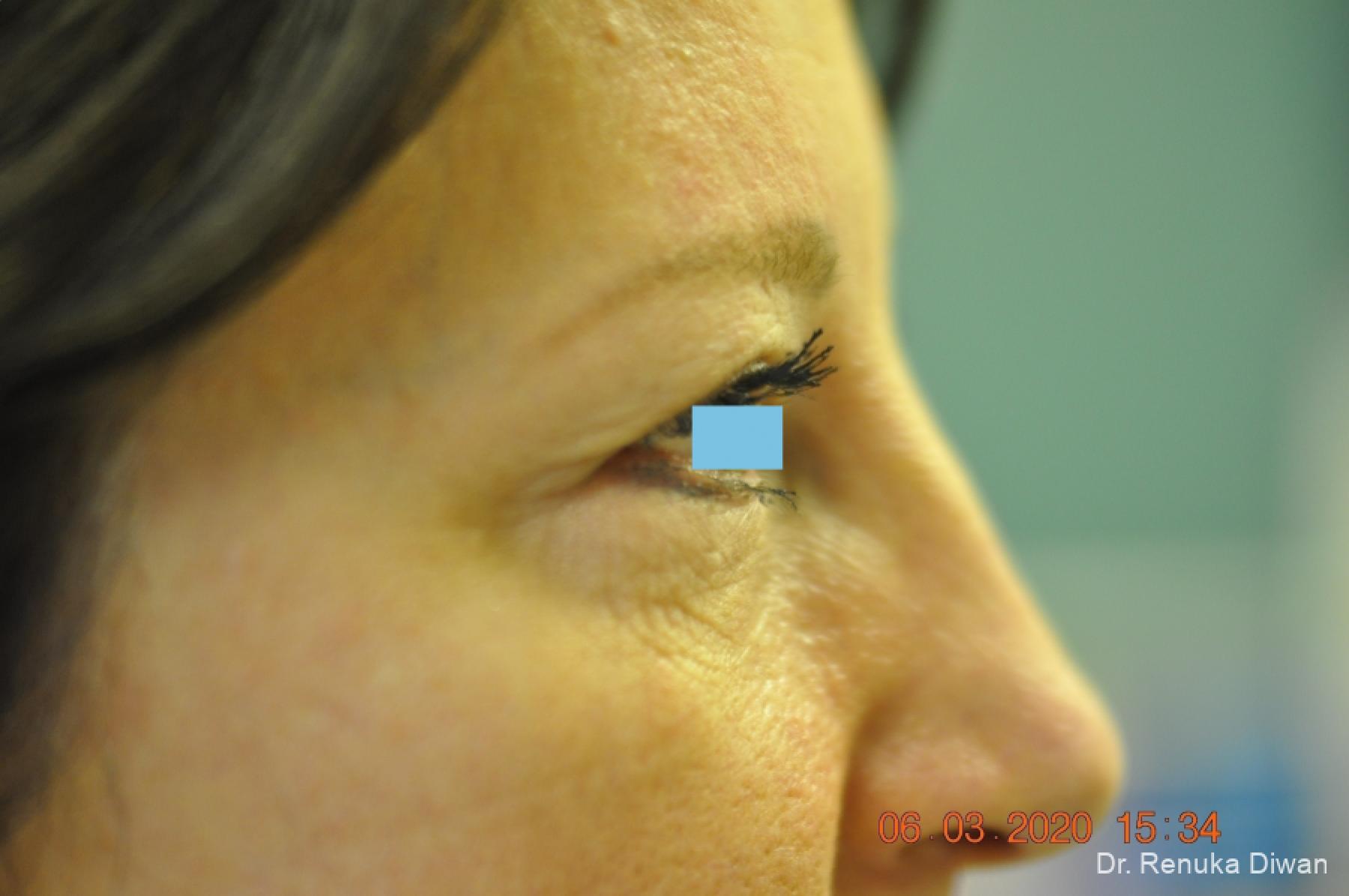 Blepharoplasty Before And After Gallery Patient 3