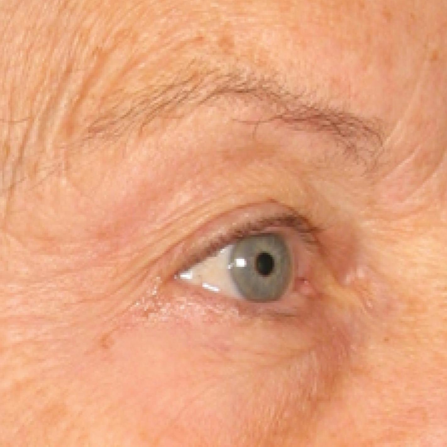 Ultherapy® - Brow: Patient 1 - After  