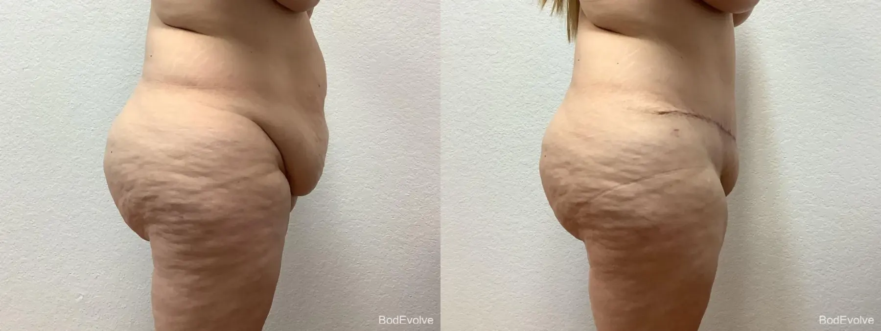 After Massive Weight Loss: Patient 2 - Before and After 5