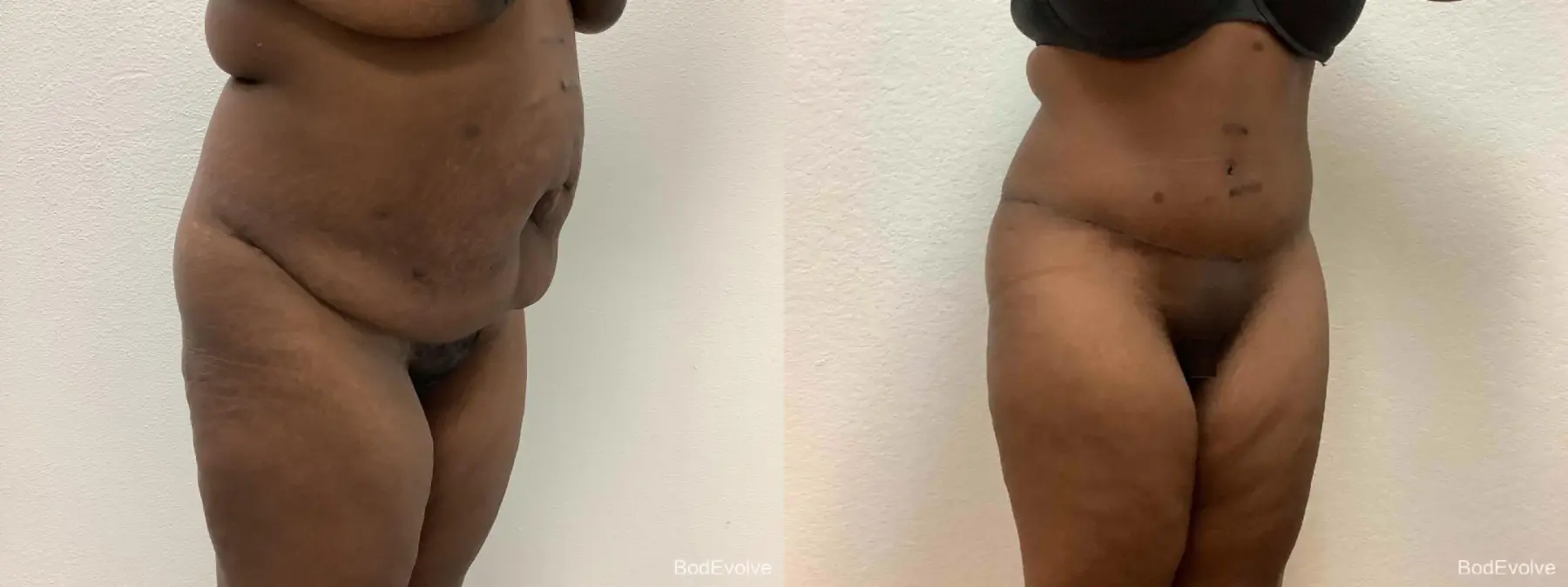 After Massive Weight Loss: Patient 5 - Before and After 4