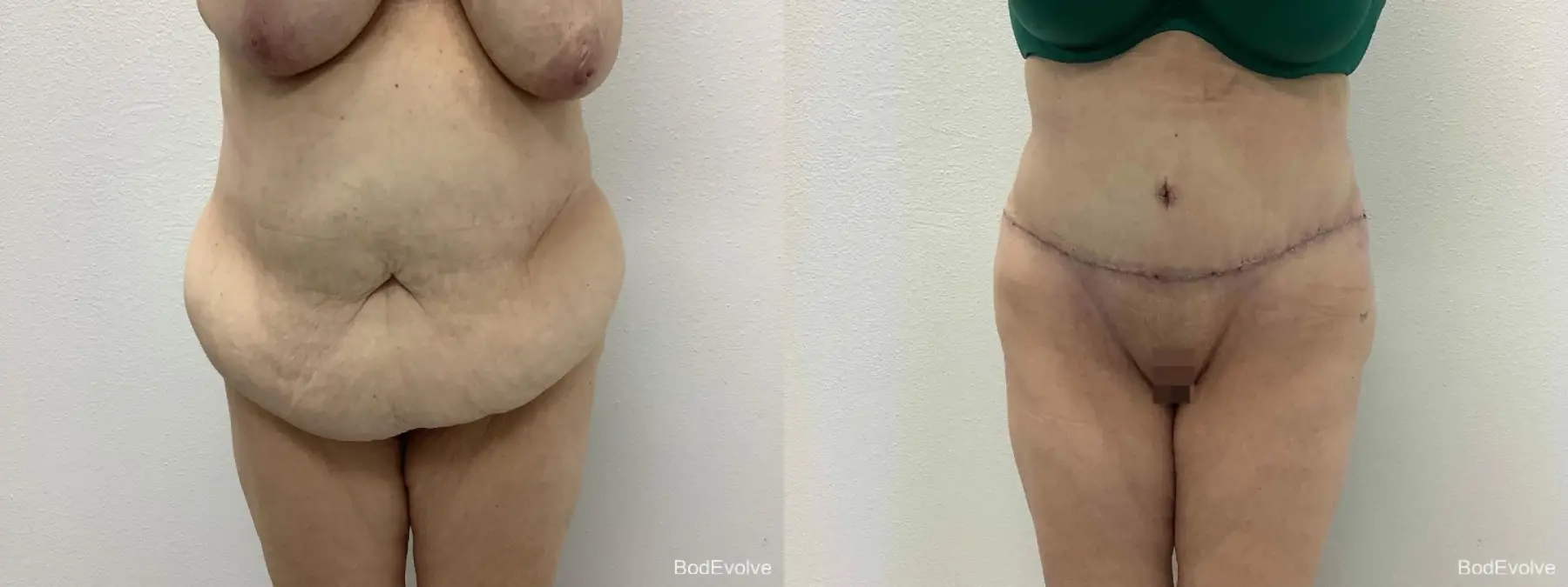 After Massive Weight Loss: Patient 2 - Before and After  